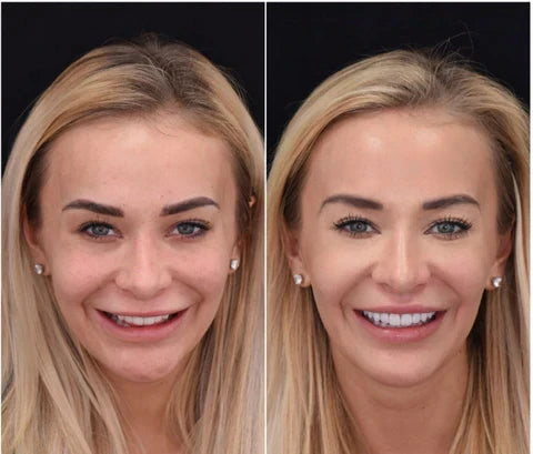 LumaGrin Instant Snap-On Veneers For Upper and Lower Teeth