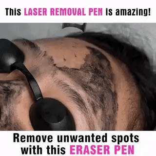 LumiDerm Laser Pen for Tattoo, Moles &amp; Freckles Removal