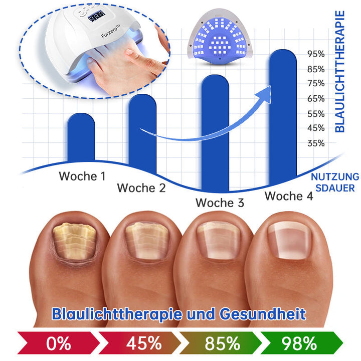 NailCure™ - Nail Fungus Laser Treatment Solution (50% DISCOUNT)