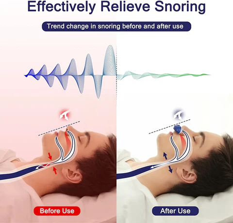 Niki | Micro CPAP Sleep Apnea Machine for Travel &amp; Anti-Snoring
