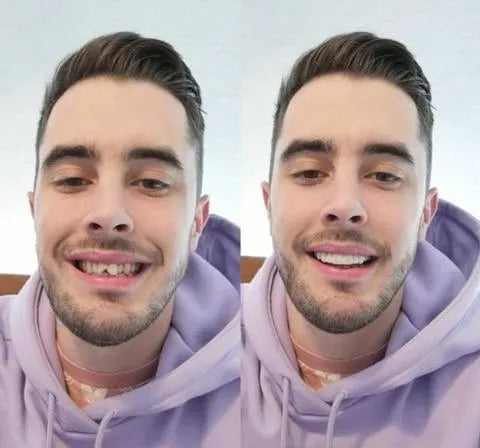 Niki | On Smile Veneers (Upper and Lower Jaw included)
