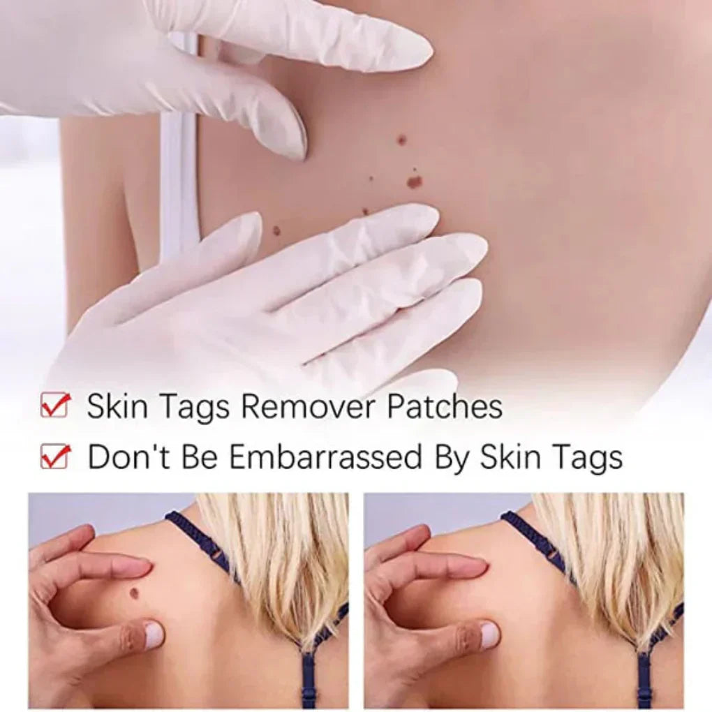 Niki | Skin Tag and Mole Removal Pen