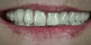 NovaBright Snap On Veneers For Upper And Lower Teeth Instant Natural Smile