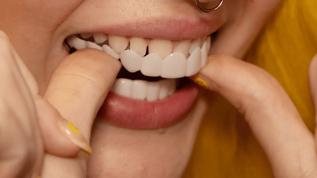 Snap on Smile Veneers (Upper &amp; Lower)